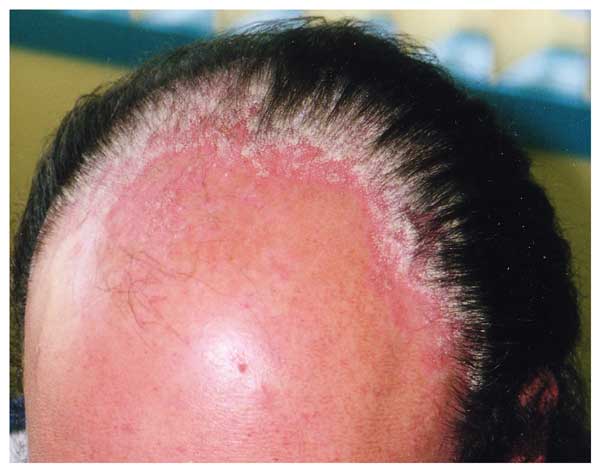 Psoriasis Scalp Formula Hair Loss Helps To Restore Growth.