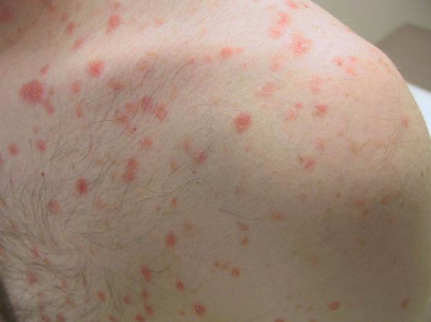 Psoriasis Caused By Diet