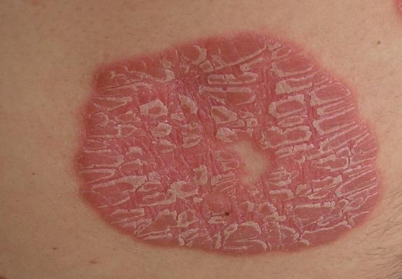 Types of Psoriasis: Medical Pictures and Treatments