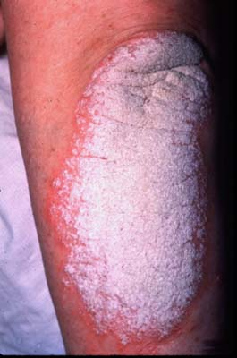 Chronic plaque psoriasis