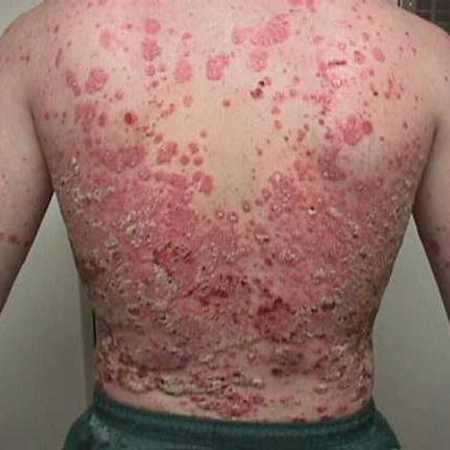 Psoriasis Guttate