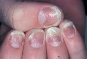 Nail Psoriasis