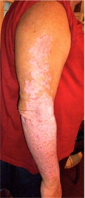 Psoriasis skin disease