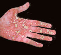 Pustular Psoriasis