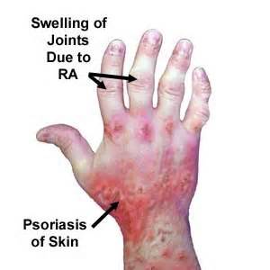 psoriasis arthritis, swollen joints,