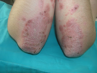 Elbow psoriasis