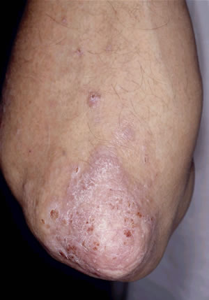 Psoriasis on the elbow