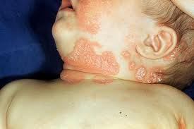 Child with psoriasis