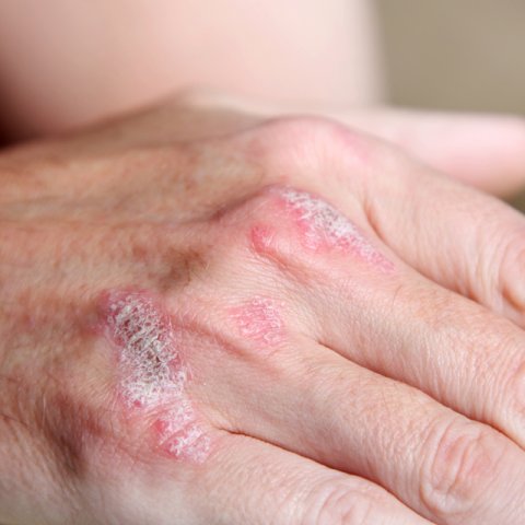 Psoriasis on hand