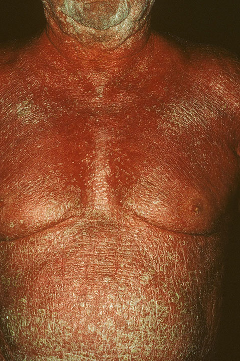 erythrodermicpsoriasis