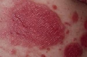 Genital psoriasis