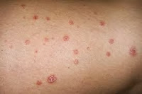 Psoriasis guttate