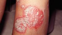 Plaque psoriasis