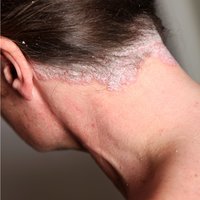 howpsoriasislook-scalp