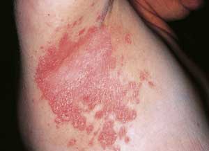 Psoriasis on the arm