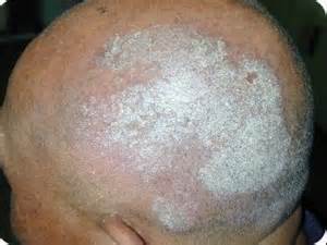 Psoriasis on the scalp