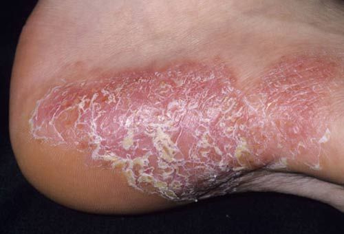 psoriasisofthefoot