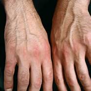 psoriaticarthritis