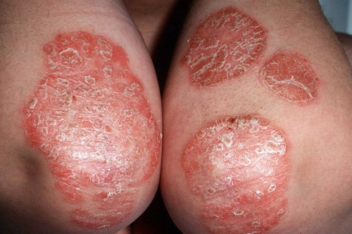 Stress related Psoriasis