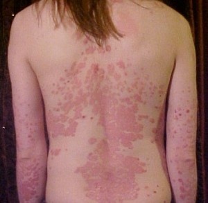 systemicpsoriasis