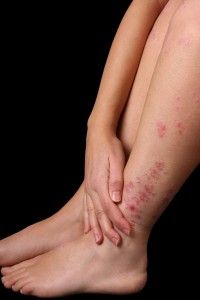 Does psoriasis spread?