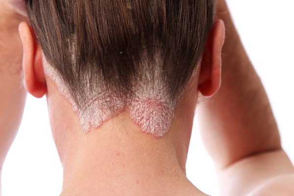 Psoriasis on the neck!