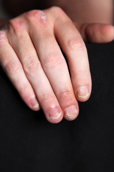 Nail and Hand Psoriasi