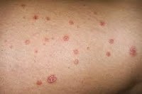 Psoriasis Guttate