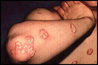 mildplaquepsoriasis