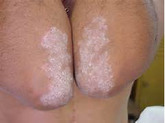 plaquepsoriasis2