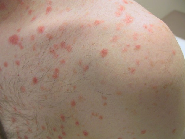 Psoriasis skin disease, guttate psoriasis,